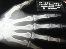 Moody hand x-ray